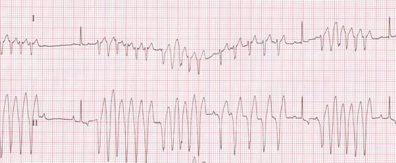 Tachycardia (Rapid Heart Beat) in Dogs – Symptoms, Diagnosis and Treatment